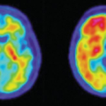 Tevredenheid over ontvangen uitslag amyloïd-PET scan