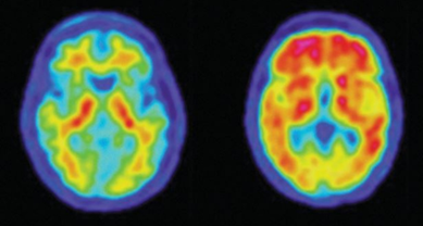 Tevredenheid over ontvangen uitslag amyloïd-PET scan